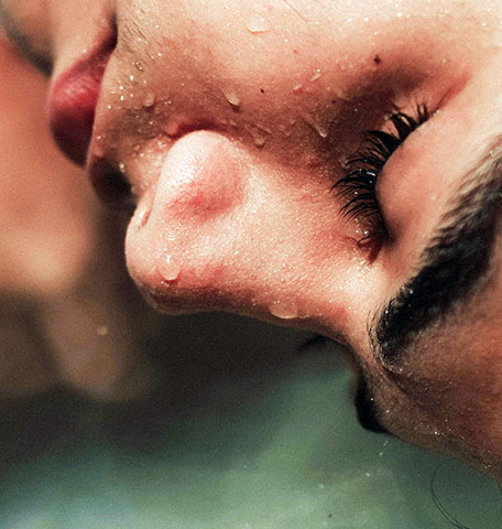 Craniofacial Hyperhidrosis